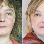 Full Face Transplant