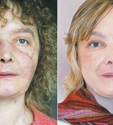 Photograph of Full Face Transplant NULL UK