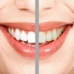 Teeth Whitening