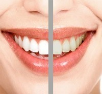 Photograph of Teeth Whitening NULL United States